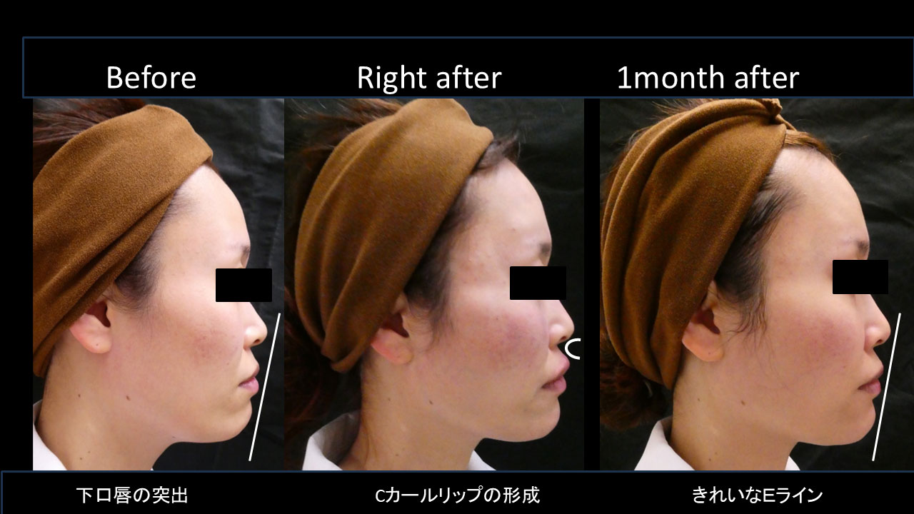 30代女性の症例写真5