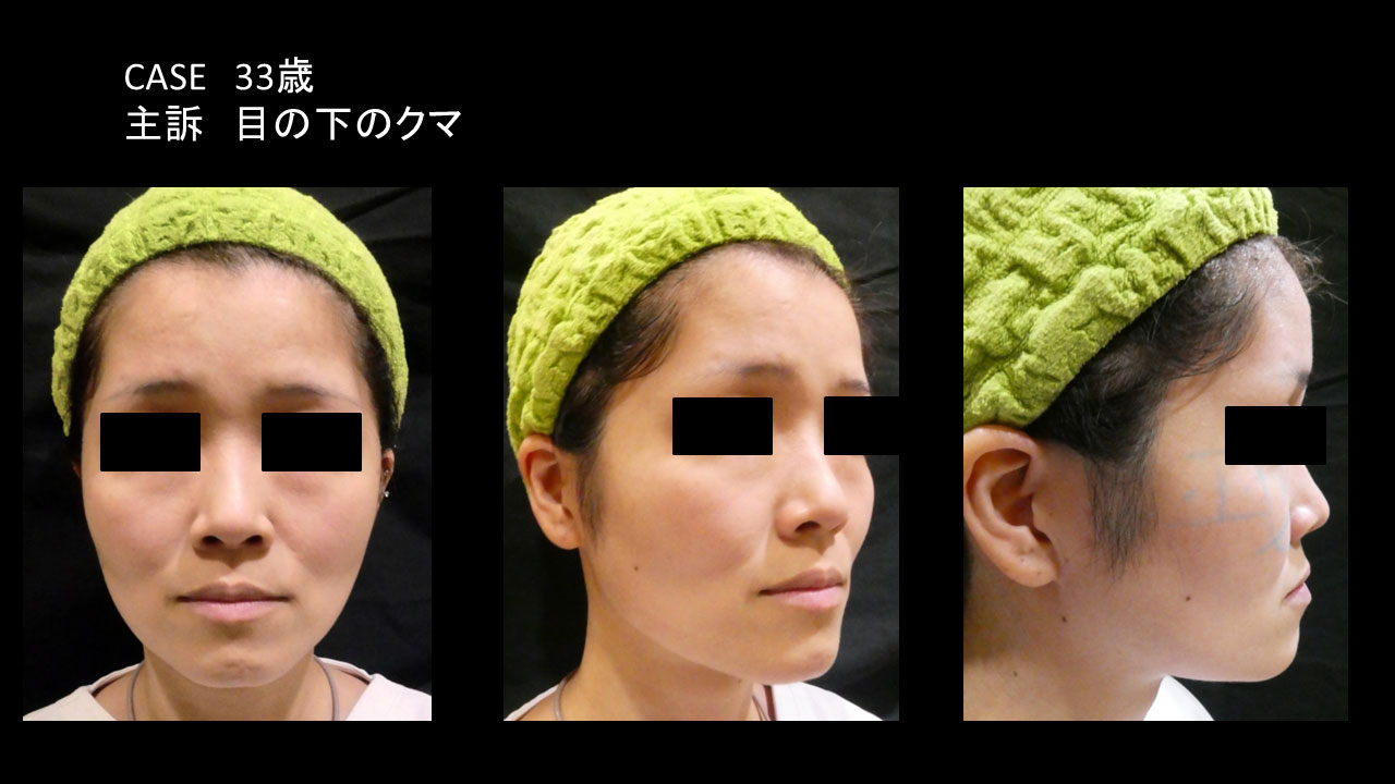 30代女性の症例写真1