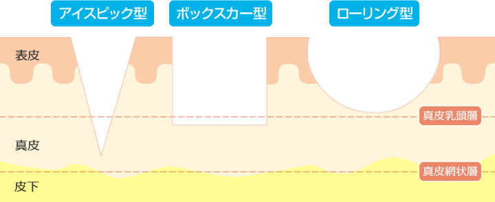 ニキビ跡（アクネスカー）の種類について