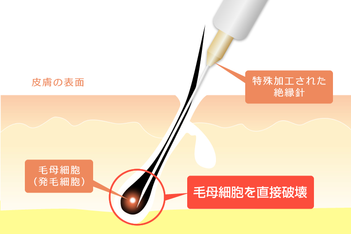 ニードル脱毛（針脱毛）の原理と仕組みの図