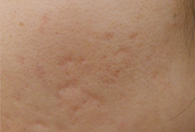 ニキビ跡治療サブシジョンの症例写真