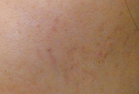 ニキビ跡治療サブシジョンの症例写真